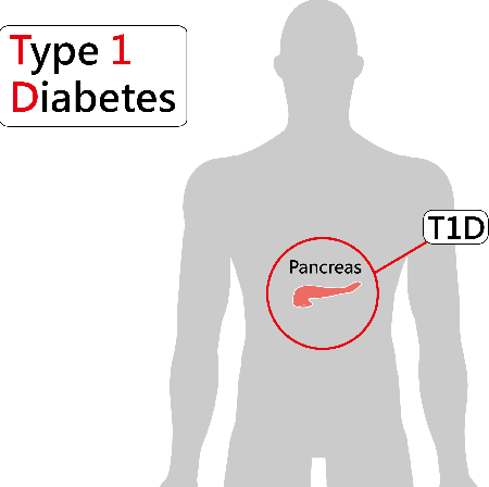 Type 1 Diabetes